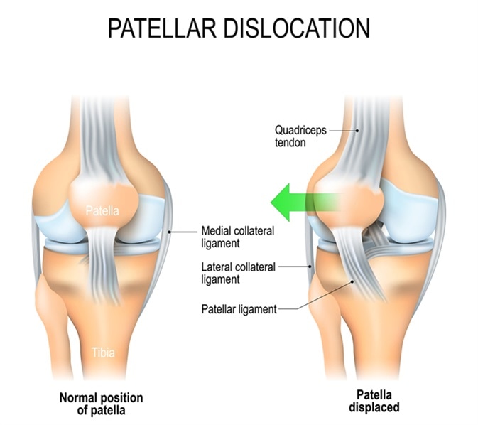 patella